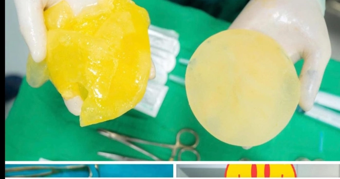 Phụ nữ đã "trùng tu" vòng 1 có nên chơi pickleball?